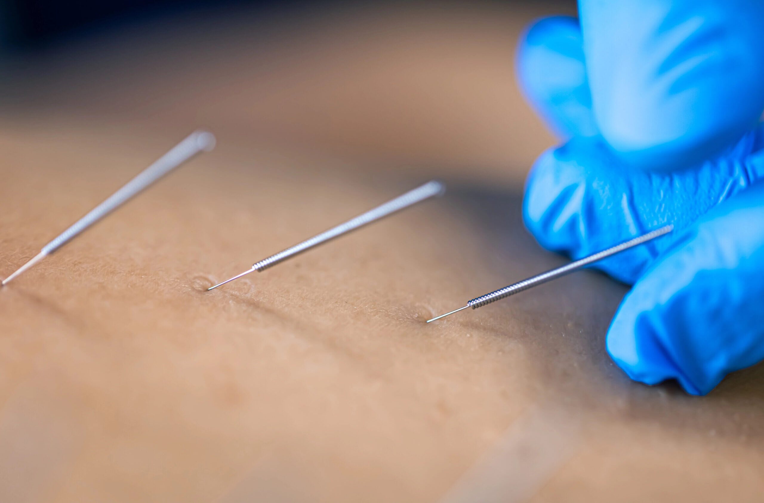 suche igłowanie_foto1